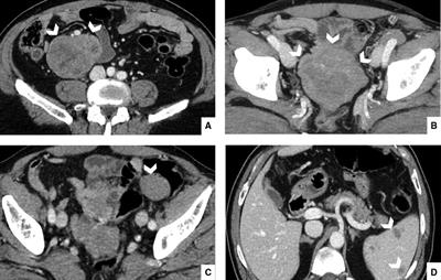 A Case Report of Multiple Gastrointestinal Stromal Tumors: Imaging Findings, Surgical Approach, and Review of the Literature